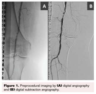 VDM Figure 1 Robotic Angio