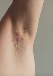 Arm pit with hidradenitis suppurativa. Pediatric patients will include various physicians for their hidradenitis suppurativa treatment.