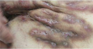Hidradenitis Suppurativa, as shown here, is a terrible condition that can affect pediatric patients and their HS treatment.