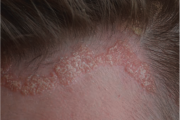 Patient with psoriasis on the scalp. Recent studies have looked into hypochondriasis in psoriasis such as this patient.