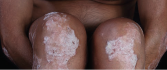 Patient with severe psoriasis on knees with a potential link to psoriatic arthritis and its differing oxylipin profile. 