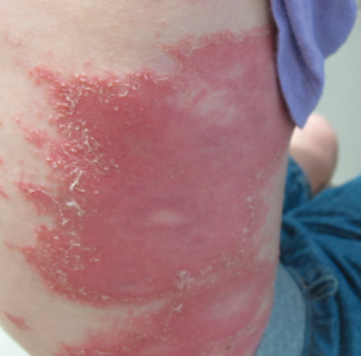 A patient suffering from a case of plaque psoriasis which is one of the many forms of psoriasis tildrakizumab was used for.
