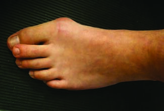 New Consensus Statement On Hallux Valgus Provides Collaboration And Clarity