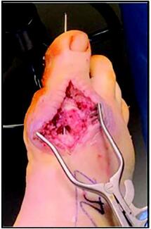 What Options Exist When Complications Arise After An Osteotomy To Avoid DFU Recurrence?