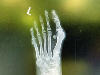 Metatarsal Head Osteotomies For Bunion Correction