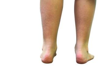 Practical Pearls For Treating Calcaneal Apophysitis