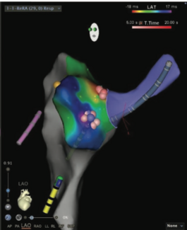 Kanjwal tachycardia thumbnail