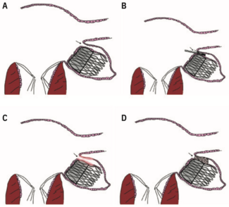 Krishnan Endocardial thumbnail