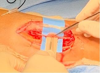 Microneurosurgery: A Guide For Diagnosing Nerve Pathology And Treatment Options In The Lower Extremity
