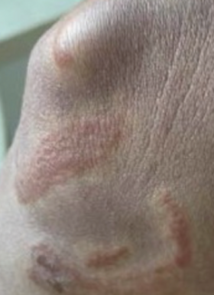 Phytophotodermatitis