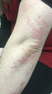 Unilateral Linear Psoriasis