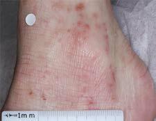 Eczema, or atopic dermatitis shown here, can have severe impacts on children and adolescent mental health.