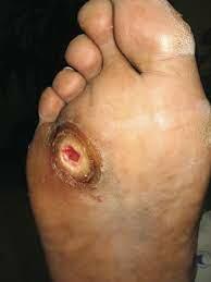 Overcoming Health Inequities In Wound Care