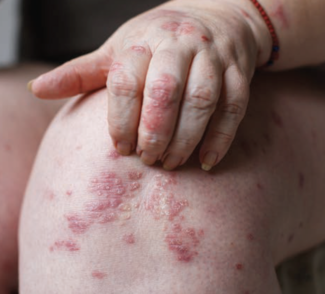 Severe psoriasis, such as plaque psoriasis shown here, can benefit from biologic agents that enable psoriasis treatment.