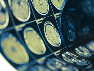 This study suggests that one day it may be possible to immediately analyze an EMS provider’s narrative to reliably identify stroke patients without the need for stroke scales. 