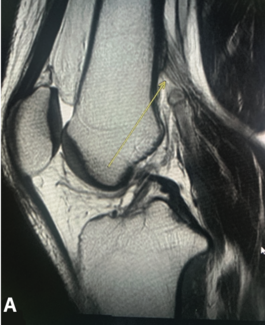 Haque Popliteal Artery thumbnail