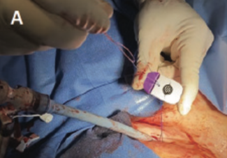 Inari-Marino Large-Bore Catheter thumbnail