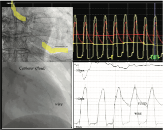 Kern Duel Lumen Pigtail thumbnail