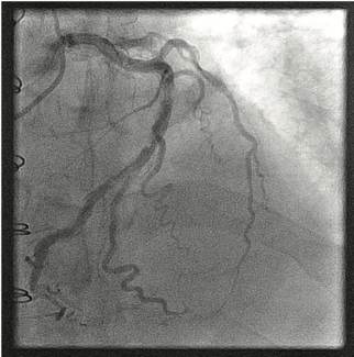 Kumar Upper Extremity Tortuosity thumbnail