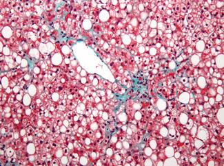 fatty liver microscopic slide