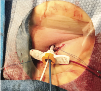 Petoskey Impella thumbnail