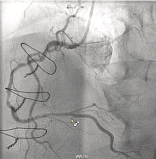 Shah RCA Perforation thumbnail