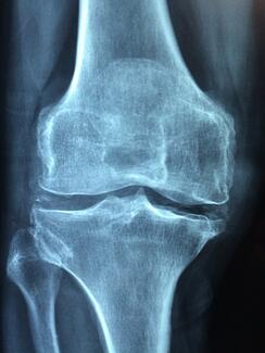 Knee xray