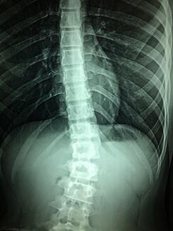 spinal xray