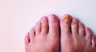 Myths in Podiatric Dermatology