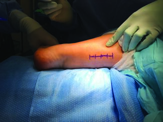 Photo courtesy of David Erfle, DPM, Lisa Thatcher, DPM and Derek Anselmo, DPM