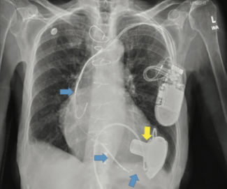 Araj Heart Failure TN