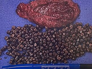 A pathologic image of a gallbladder with many gallstones. (Photo: patient, used with consent) 