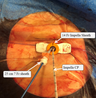 Gajanan Impella thumbnail