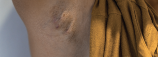 hidradenitis in armpit