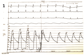Katz Aortic Stenosis thumbnail