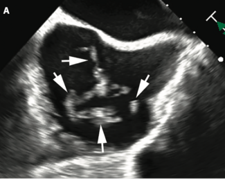 Kumar Thrombus thumbnail