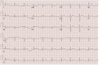 Olezsak stent thumbnail