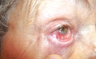 Cicatricial pemphigoid  