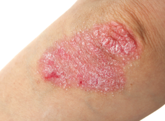 Psoriasis on the elbow