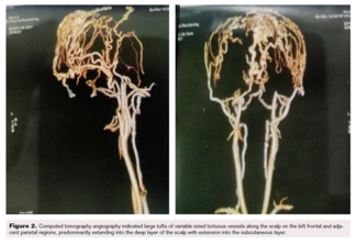 Figure 2 Tortuous vessels