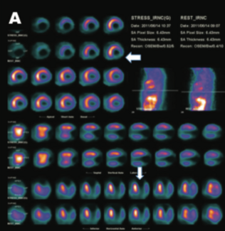 Torres Aneurysm thumbnail