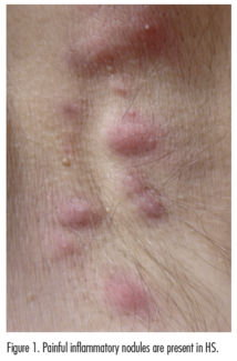 hidradenitis