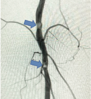 Adams Thrombotic Occlusions TN