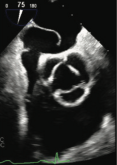 Bakhsh Platypnea-Orthodeoxia TN