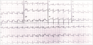 Beohar STEMI Covid TN