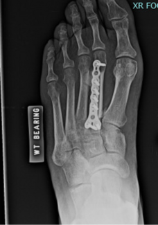 Fibular Autograft for Foot Reconstruction