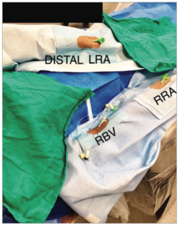 Casazza Radial Access TN