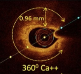 Chhikara Stuck OCT Catheter TN