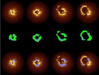 Cilingiroglu DIAMOCT-PAD TN