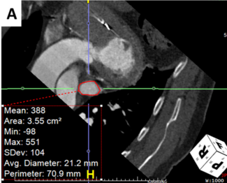 Dallan Atrial Appendage Occlusion TN
